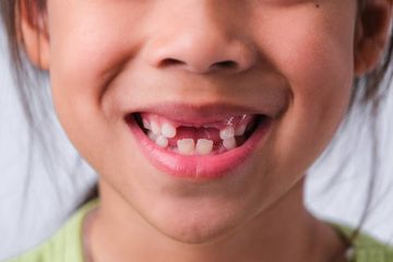 Pérdida Temprana de Dientes Primarios: Causas, Implicaciones y Prevención