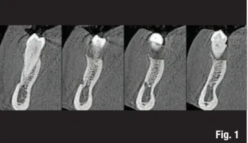 Valutazione CAD dei cambiamenti dimensionali dopo l’utilizzo di matrici in collagene volumetricamente stabili nei difetti orizzontali vestibolari contestualmente all’inserimento implantare. Uno studio pilota