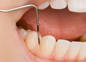 Membranas separadoras na prática da periodontologia cirúrgica