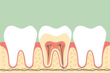 Identificazione e Caratterizzazione di una Struttura Anatomica Precedentemente Sconosciuta nei Secondi Molari Mascellari: il Canale Palato-Mesiobuccale