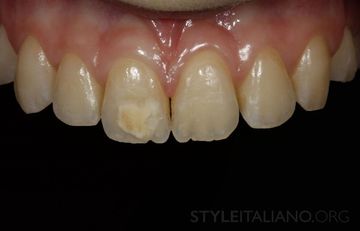 Trattamento minimamente invasivo delle macchie sui denti