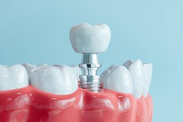 Feasibility of Using a Prosthetic-Based Impression Template to Improve the Trueness and Precision of a Complete Arch Digital Impression on Four and Six Implants: An In Vitro Study