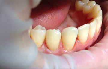 Perizervikale Wiederherstellung und Gingivektomie Perizervikale Wiederherstellung und Gingivektomie