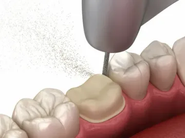 Instrumentos para preparação de dentes