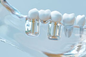 CAD Evaluation of Dimensional Changes After Using Volumetrically Stable Collagen Matrices in Vestibular Horizontal Defects Concurrent with Implant Placement. A Pilot Study CAD Evaluation of Dimensional Changes After Using Volumetrically Stable Collagen Matrices in Vestibular Horizontal Defects Concurrent with Implant Placement. A Pilot Study