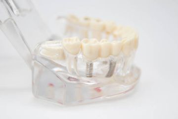 The Ferrule Effect in Restorative Dentistry