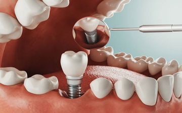 Management of peri-implant soft tissues in post-extraction implant placement with digitally customized healing abutments. A clinical case. Management of peri-implant soft tissues in post-extraction implant placement with digitally customized healing abutments. A clinical case.