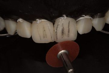 Resina composita come imitazione del dente vero