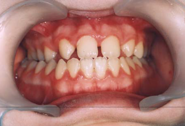 Treatment protocol for unilateral posterior crossbite