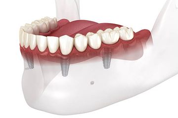 Viabilidad del uso de una plantilla de impresión basada en prótesis para mejorar la veracidad y precisión de una impresión digital de arco completo en cuatro y seis implantes: un estudio in vitro. Viabilidad del uso de una plantilla de impresión basada en prótesis para mejorar la veracidad y precisión de una impresión digital de arco completo en cuatro y seis implantes: un estudio in vitro.