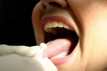 Lesiones de la mucosa por hipovitaminosis.