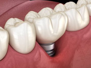 Histomorphometry of Bone after Intentionally Exposed Non-Resorbable d-PTFE Membrane or Guided Bone Regeneration for the Treatment of Post-Extractive Alveolar Bone Defects with Implant-Supported Restorations: A Pilot Randomized Controlled Trial