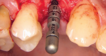 Implantación inmediata retrasada con aumento estable en volumen