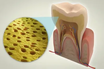 Dentinempfindlichkeit. Ursachen und Lösungen Dentinempfindlichkeit. Ursachen und Lösungen