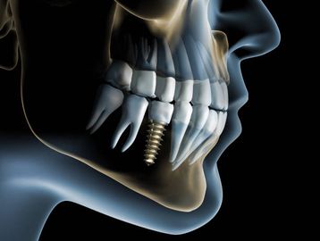 Dental implants treatment outcomes in patient under active therapy with alendronate: 3-year follow-up results of a multicenter prospective observational study Dental implants treatment outcomes in patient under active therapy with alendronate: 3-year follow-up results of a multicenter prospective observational study