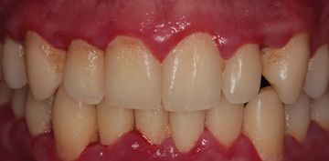 Complicaciones durante y después de la profilaxis dental Complicaciones durante y después de la profilaxis dental