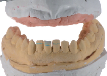 Implantes extra longos (20, 22 e 25 mm) para reabilitação total fixa implantossuportada Implantes extra longos (20, 22 e 25 mm) para reabilitação total fixa implantossuportada