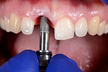An in-vitro study on accuracy of modular templates used to fully guide implants in combination with bone reduction for complete arch restorations: Experts versus students