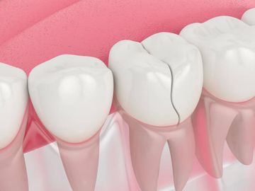 Micro–computed Tomographic Assessment on the Effect of ProTaper Next and Twisted File Adaptive Systems on Dentinal Cracks