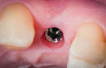 Semi-individualisierte dreidimensionale ultrafeine Titan-Maschen in der geführten Knochenregeneration für die Implantattherapie bei schweren alveolären Knochendefekten: ein Fallbericht