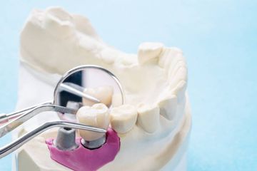 Knochenaugmentation und Implantatrestauration in einer kompromittierten ästhetischen Zone: ein Fallbericht Knochenaugmentation und Implantatrestauration in einer kompromittierten ästhetischen Zone: ein Fallbericht