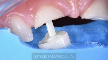 Trattamento delle fratture dei denti anteriori