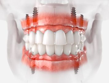 An up to 7-Year Retrospective Analysis of Biologic and Technical Complication With the All-on-4 Concept An up to 7-Year Retrospective Analysis of Biologic and Technical Complication With the All-on-4 Concept