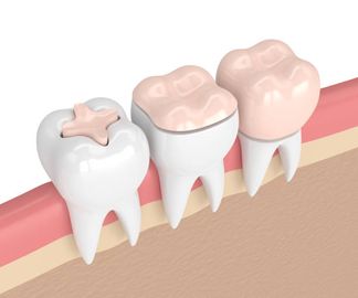 Atraumatic restorative treatment and minimal intervention dentistry