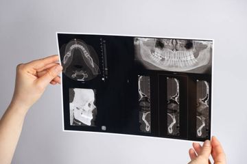 Evaluación de micro-CT de la calidad del sellado de conductos en canales de forma ovalada