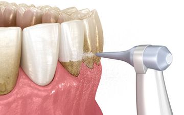 Placca Dentale. Composizione, Struttura, Sviluppo, Classificazione. Placca da Macchia Nera. Lucidatura Meccanica nell'Igiene Dentale Professionale