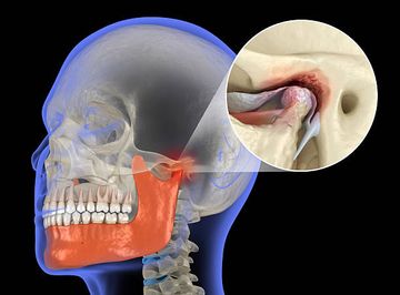 The ESTMJS (European Society of Temporomandibular Joint Surgeons) Consensus and Evidence‐Based Recommendations on Management of Condylar Dislocation The ESTMJS (European Society of Temporomandibular Joint Surgeons) Consensus and Evidence‐Based Recommendations on Management of Condylar Dislocation