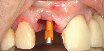 "O parafuso perfeito" em pacientes mais velhos (Parte 3) "O parafuso perfeito" em pacientes mais velhos (Parte 3)