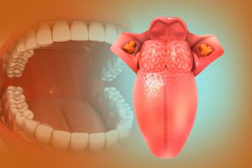 Липомы полости рта