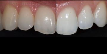 Teeth Whitening: Perfection and Comfort