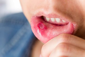 Types of injuries to the oral mucosa