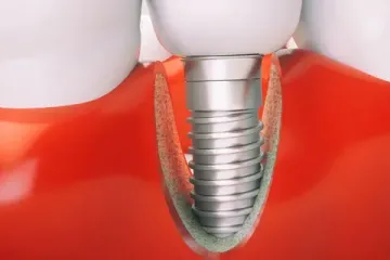 Осложнения дентальной имплантации