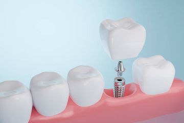 Skeletal Anchorage in Orthodontics. Temporary Anchorage Devices (TADs): Mini-Screws