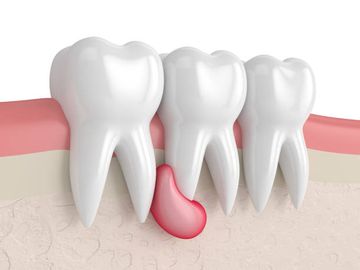 Aplicación de radiomica en el diagnóstico diferencial de ameloblastomas y quistes dentígeros