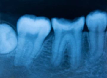 Valutazione critica di alcuni aspetti metodologici dell'uso della tecnologia micro-CT nello studio delle microfessure dentinali in endodonzia