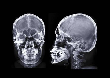 Dystrophische Verkalkung der Ohrspeicheldrüsen bei Sjögren-Syndrom Dystrophische Verkalkung der Ohrspeicheldrüsen bei Sjögren-Syndrom
