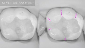 Principais linhas da anatomia oclusal