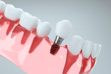 Estudio Prospectivo de Cinco Años sobre el Fallo de Implantes y el Remodelado Óseo Marginal Esperado Usando Implantes de Nivel Óseo con Superficie Arenada/Ácida y Conexión Cónica