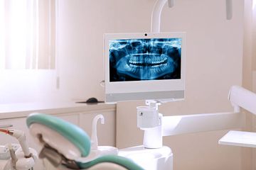 Evaluación de micro-CT de las calcificaciones de la pulpa radicular en dientes molares maxilares extraídos