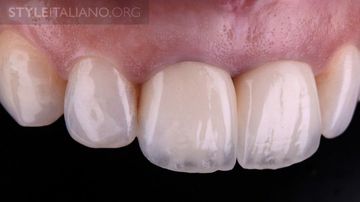 Polarisierte Dentalfotografie