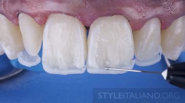 Aesthetic Restorations with Composite Materials