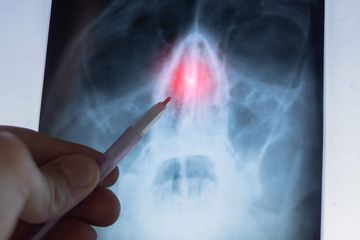 Chronische maxilläre Sinusitis dentalen Ursprungs: Ist ein externer chirurgischer Ansatz zwingend erforderlich? Chronische maxilläre Sinusitis dentalen Ursprungs: Ist ein externer chirurgischer Ansatz zwingend erforderlich?