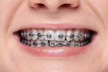 Guidelines for Orthodontic Considerations in Impaction of Maxillary Central Incisor with Dilaceration Guidelines for Orthodontic Considerations in Impaction of Maxillary Central Incisor with Dilaceration