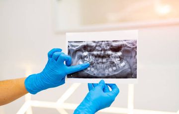 Tendenze di pubblicazione nella ricerca endodontica con micro-CT: un'analisi bibliometrica su un periodo di 25 anni