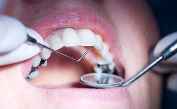 Posterior composite restoration update: focus on factors influencing form and function Posterior composite restoration update: focus on factors influencing form and function