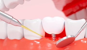 Ensayo Controlado Aleatorizado Multicéntrico de un Año Comparando los Adjuntos OT Equator® y Locator para Retener una Sobredentadura de Implante Cargada Tempranamente sobre Dos Implantes